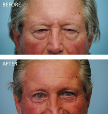 75 and over year old male treated with Browlift A