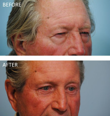 75 and over year old male treated with Browlift B