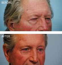 75 and over year old male treated with Browlift