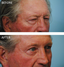 75 and over year old male treated with Browlift C