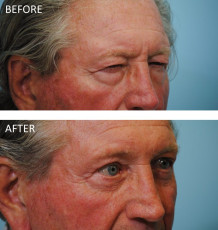 75 and over year old male treated with Browlift