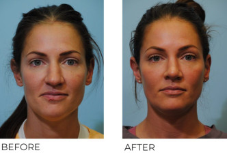 35-44 year old female treated with Rhinoplasty