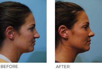 35-44 year old female treated with Rhinoplasty