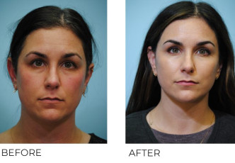35-44-year-old-woman-treated-with-Facelift-1-year-ago