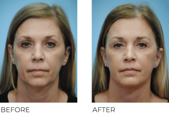 45-54 Year Old Woman Treated with Facelift 6 Months Post-Op