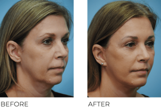 45-54 Year Old Woman Treated with Facelift 6 Months Post-Op