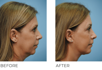 45-54 Year Old Woman Treated with Facelift 6 Months Post-Op