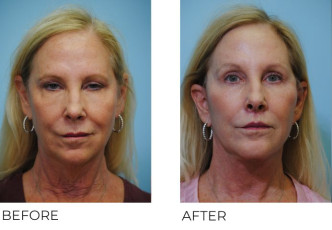 55-64-year-old-woman-treated-Facelift-ptosis-repair-and-upper-lip-lift-3-months-postop