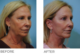 55-64-year-old-woman-treated-Facelift-ptosis-repair-and-upper-lip-lift-3-months-postop