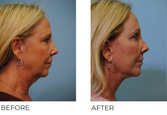 55-64-year-old-woman-treated-Facelift-ptosis-repair-and-upper-lip-lift-3-months-postop