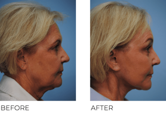 65-74 Year Old Woman Treated with Facelift 5 Months Post- Op