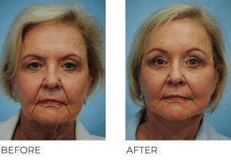 65-74 Year Old Woman Treated with Facelift 5 Months Post- Op