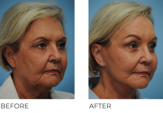 65-74 Year Old Woman Treated with Facelift 5 Months Post- Op