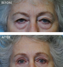 75 and over female treated with Ptosis