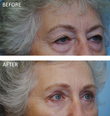 75 and over female treated with Ptosis