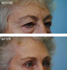 75 and over female treated with Ptosis