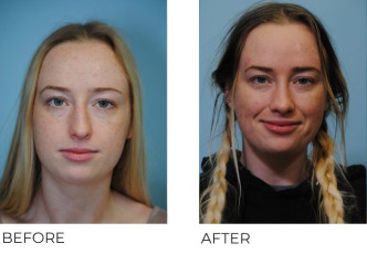 18-24-year-old-woman-treated-with-Rhinoplasty-2-years-postop