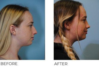 18-24-year-old-woman-treated-with-Rhinoplasty-2-years-postop