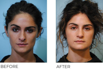 18-24 year old woman treated with Rhinoplasty 6 weeks postop