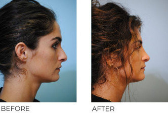 18-24 year old woman treated with Rhinoplasty 6 weeks postop