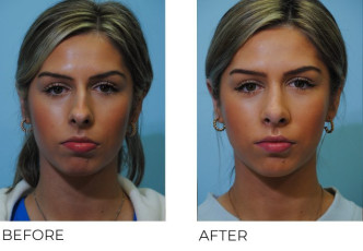 18-24 year old woman treated with Rhinoplasty