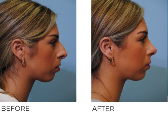 18-24 year old woman treated with Rhinoplasty