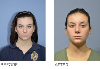 18 year old female treated with Rhinoplasty and Septoplasty, 5 months post-op