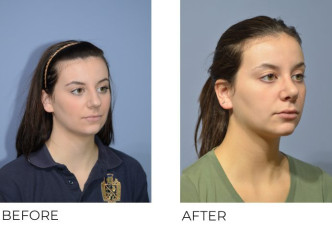 18 year old female treated with Rhinoplasty and Septoplasty, 5 months post-op