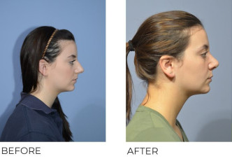 18 year old female treated with Rhinoplasty and Septoplasty, 5 months post-op