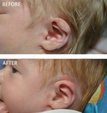 2 week old infant treated for ear deformity with EarWell Correction Left Ear, 8 weeks post-correction A