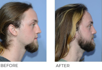 21 year old male treated with Rhinoplasty and Tip Plasty, 2 month post-op