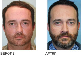 35-44-Year-Old-Man-Treated-With-Rhinoplasty-2-Years-Post-Op A