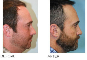35-44-Year-Old-Man-Treated-With-Rhinoplasty-2-Years-Post-Op B