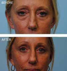 35-44 year old woman treated with Ptosis Repair 3 mths postop