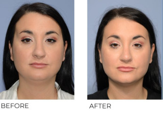 36 year old female treated with Revision Rhinoplasty, 2 months post-op A