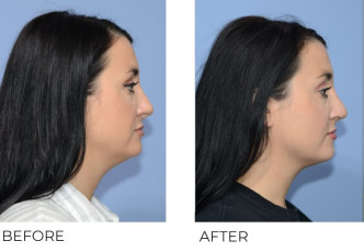 36 year old female treated with Revision Rhinoplasty, 2 months post-op B