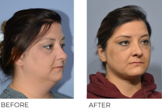 37 year old female treated with Cervical Liposuctiona and Small Implant Genioplasty, 5 months post-op