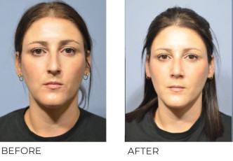 37 year old female treated with a Rhinoplasty, 2 months post-op