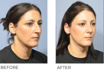 37 year old female treated with a Rhinoplasty, 2 months post-op