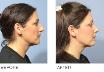 37 year old female treated with a Rhinoplasty, 2 months post-op