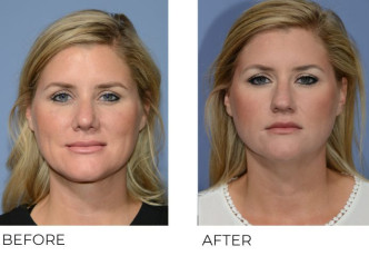 38 year old female treated with Cervical Liposuction and Rhinoplasty, 2 weeks post-op