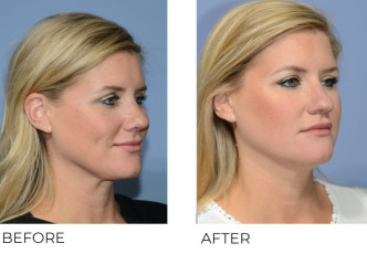 38 year old female treated with Cervical Liposuction and Rhinoplasty, 2 weeks post-op