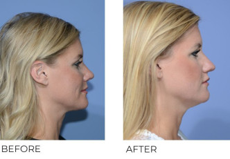 38 year old female treated with Cervical Liposuction and Rhinoplasty, 2 weeks post-op