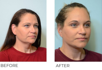 47 year old female treated with a Facelift and Endoscopic Browlift with Tines, 1 month post-op