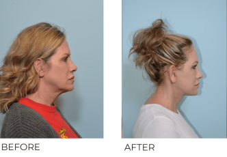 53 year old female Facelift Endoscopic Browlift and Cervial Liposuction 1 month post-op