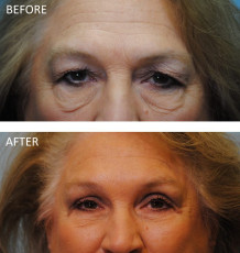 65-74 year old woman treated with Browlift