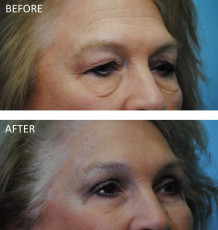 65-74 year old woman treated with Browlift