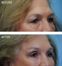 65-74 year old woman treated with Browlift