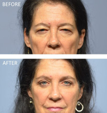 68 year old female treated with Bilateral Upper Blepharoplasty and Bilateral Lower Blepharoplasty, 1 month post-op