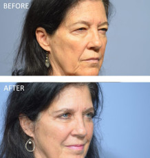 68 year old female treated with Bilateral Upper Blepharoplasty and Bilateral Lower Blepharoplasty, 1 month post-op